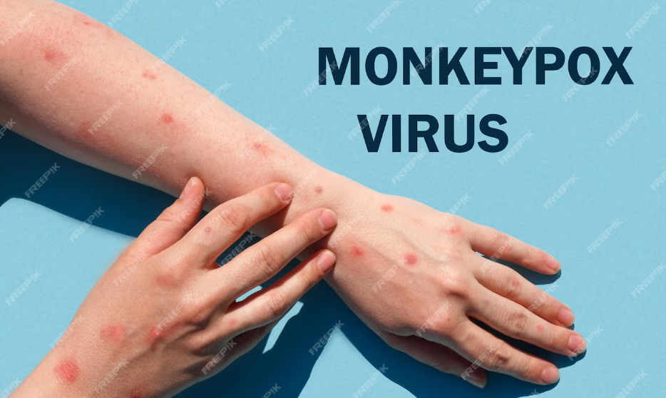 Thailand Awasi Ketat Masuknya Varian Ganas Cacar Monyet Clade 1b